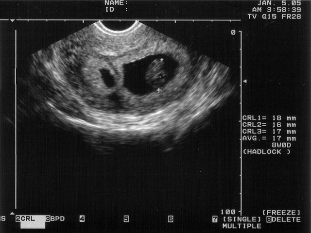 8 week ultrasound fraternal twins